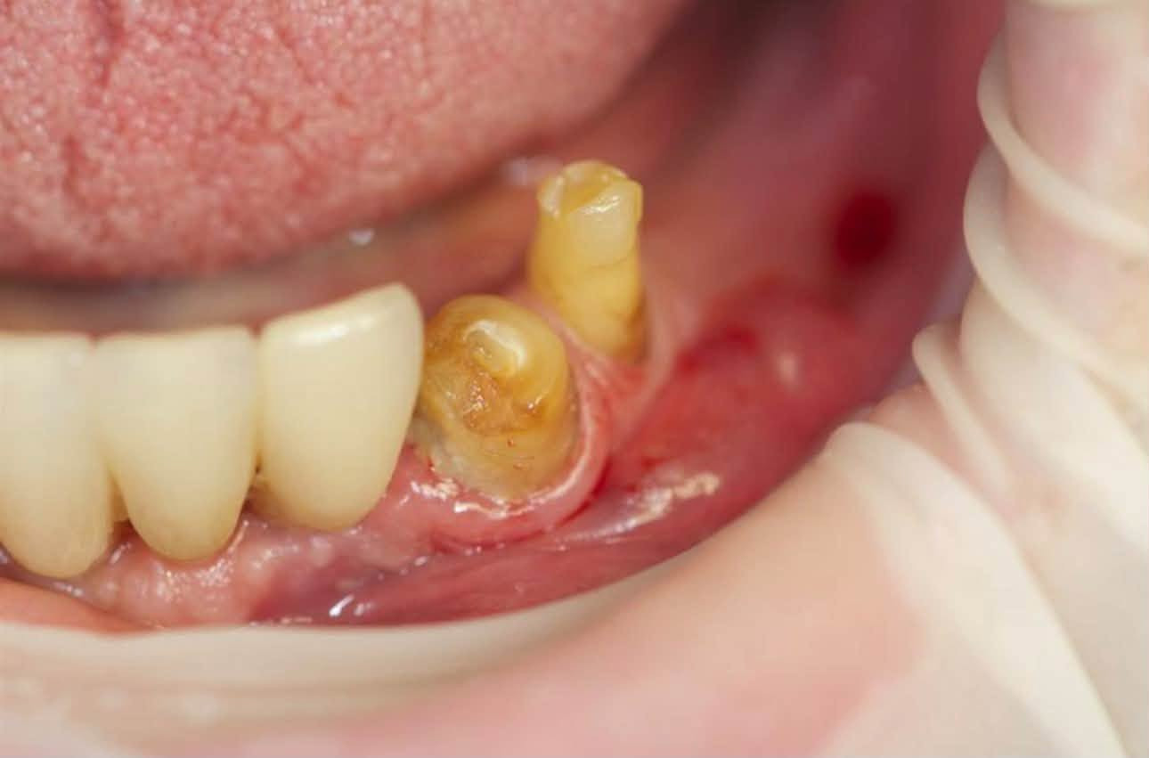 علاج مجاني بالكامل ‼️
لحالات التسوس بالحشوات التجميلية
قلع الجذور التالفة
تنظيف الاسنان من التكلسات و التصبغات 
تعويض الاسنان المفقودة بطقم متحرك 
العنوان: 
عيادات جامعة الهادي/ نهاية شارع 60
التواصل على الرقم 
***********
