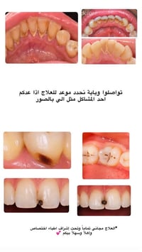 مرحبا تعلن عيادات جامعة المشرق عن توفر خدمات طب الأسنان بإشراف أطباء ا...