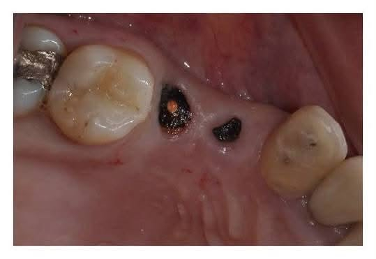 السلام عليكم 🌷🦷
حاليًا أستقبل بعض الحالات لعلاج الأسنان بشكل مجاني ، واللي يحتاج علاج أو يعرف أحد محتاج يراسلني خاص حتى أشوف الحالة وأوضح التفاصيل.

الحالات اللي أشتغل عليها حاليًا للكبار او الاطفال :
• حشوات الأسنان (حشوه بيضاء بلون السن بجلسه واحده)
• تنظيف وعلاج اللثة 
• قلع الأسنان والجذور التالفه
• تعويض الاسنان بطقم متحرك 
• العلاج بماده الفلورايد والسيلر لاسنان الاطفال
• وبعض الحالات الأخرى حسب الحالة

📍 المكان: [بابل طريق حله نجف عيادات جامعه المستقبل]
📩 للتفاصيل والحجز مراسلتي خاص.
     او واتساب ***********

الصور الي جوه توضيحيه مو تشوفوهن وتشردون🌚😂

نص مكتوب في الصور:
- تقويم الأسنان تعويض الأسنان بطقم متحرك حشوات تجميلية العلاج مجاني في بابل قلع الأسنان علاج أسنان الأطفال حشوات قلع العلاج الوقائي لأسنان الأطفال بالفلورايد والسيلر تنظيف الأسنان أسنان صحية ابتسامة أجمل مستقبل أفضل Small steps Big smiles Dentistry Oral Health Better Smiles