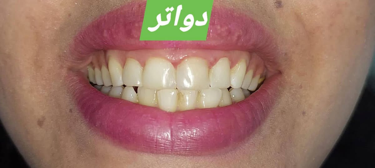 #fyp #foryou نمونەی کارەکانمان#چوارقوڕنە دوسایدی گۆڕان تەلاری نور بەرامبەر ساردەمەنی قەرەسەد ☎️***********
