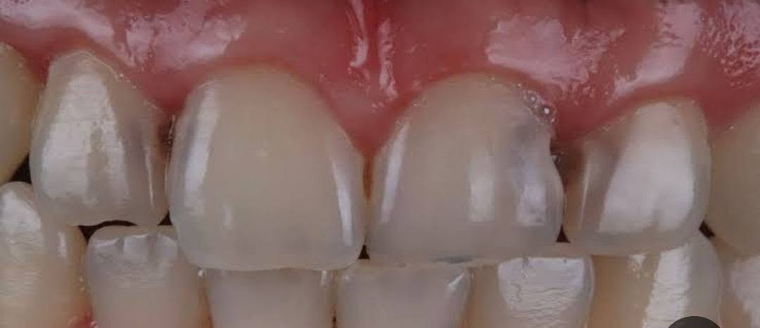 🦷 حشوات أسنان مجانية 🤍

أي شخص محتاج حشوة أسنان مجاناً، باچر متوفر علاج الساعة 12 ظهراً.

📍 الجمعية – خلف مول الحارث

 التواصل على الخاص أو على الرقم:
📞 ***********
