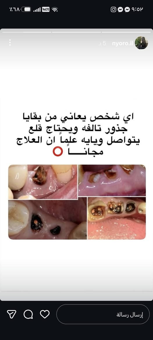 للتواصل واتساب ***********

نص مكتوب في الصور:
- تعلن كلية طب الاسنان في جامعة الهادي عن فتح عياداتها لاستقبال المراجعين لعلاج الحالات التالية:
- 1.حشوات ضوئية
- 2.قلع الاسنان التالفة وبقايا جذور الاسنان
- 3.تنظيف الاسنان وازاله التكلسات
- 4.تعويض الاسنان بتخم كامل متحرك (لكبار السن)
- 5.حشوات الجذور
- 7.عيادات خاصه ووقت خاص لاسنان الاطفال
- العنوان: الدورة/نهاية شارع 60 / مقابل كنيسة بطرس وبولص
- العلاج مجاني للاستفسار التواصل على الخاص
- nyoro.il 7 د تنظيف الاسنان من التكلسات شرط عندكم تكلسات مثل هالصوره ✨ العلاج مجاناً ✨
- اي شخص يعاني من بقايا جذور تالفه ويحتاج قلع يتواصل ويايه علمًا ان العلاج مجاناً
- تعويض الاسنان المفقوده مثل هالصوره بطقم كامل متحرك
- تعويض الاسنان المفقوده بطقم كامل متحرك