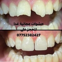 حشوات مجانية • غدا ١٠ص • عيادة