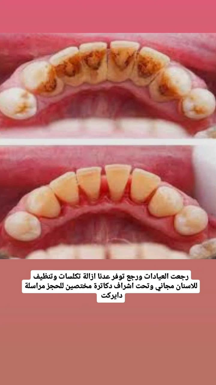 تكدر تحجز موعدك داخل عياداتنا التعليمية لتلقي العلاج بشكل مجاني
.

لحجز موعدك او الاستفسار تكدر تتواصل ويانه على :

.

📞:***********

Telegram: @f23ot

Instagram: @f22ot 

.

العنوان : البصرة _الجنينه _ شارع التجاري _ جامعة المعقل الاهلية Singapore

نص مكتوب في الصور:
- د. فاطمه الأحمد قلع الاسنان والجذور المتهالكة حشوات تجميلية تركيب اطقم متحركة تنظيف اسنان وازالة التكلسات جلسة فلورايد للاطفال لحماية الاسنان من التسوس @f22ot *********** البصرة_الجنينه_شارع التجاري_جامعة المعقل الاهلية
- اللي عنده جذور اسنان متبقية او اسنان متسوسه بشكل كامل ويريد يقلع يتواصل وياي دايركت القلع مجاناً
- رجعت العيادات ورجع توفر عدنا ازالة تكلسات وتنظيف للاسنان مجاني وتحت اشراف دكاترة مختصين للحجز مراسلة دايركت
- dr.fatima alahmed
- (Bring it on 'cause there's gon' be shit tonight) At the starting of the week At summit talks, you'll hear them sp drfatima alahmed