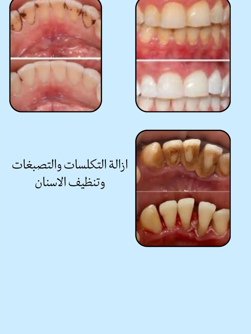 علاج مجاني • حشوات بيضاء • جامعة القادسية