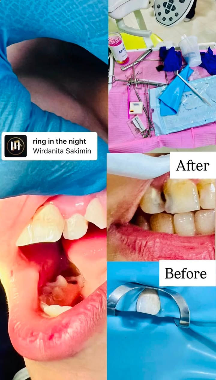 مجاناً….مجاناً…مجاناً
السلام عليكم تم فتح باب العيادات الهاي السنه و الحجز محدود نوفر الكم 
🦷تنضيف اسنان باحدث الادوات
🦷حشوات جذور وتجميليه بتقنيات متطوره
🦷قلع الاسنان التالفه
🦷تعويض طقم اسنان مفقوده
🦷تقويم اسنان حسب الحاله يحدد بعد الفحص
👶عيادات اطفال خاصه للعينايه و الوقايه من التسوس
العنوان كراده ساحه الاندلس عيادات جامعه الاسراء 
للتواصل ***********
