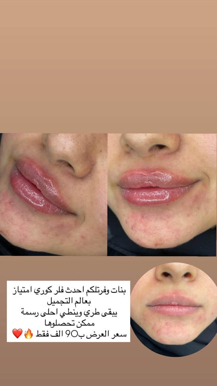 زيركون بسماية
نظام التقسيط يشمل جميع الاقسام وبدون مقدمة

والفحص مجانا 🥰

✨ جمالكِ مُهمتنا…..
شفايف منحوتة بعناية… امتلاء ناعم بدون مبالغة 💋
نتيجة طبيعية تخلي الكل يلاحظ بدون ما يعرف السر .

الدكتورة زهراء نجاح الحسيني حاصلة على سرتفكيت في تجميل الوجه اللاجراحي

علماً ان جميع المواد المستخدمة من براندات ووكالات عالمية ومرخصة من وزارة الصحة العراقية
———————————————————
بغداد-مقابل باب مجمع بسماية الالكتروني B الخدمي الراجع من بغداد عمارة كافي حنوش
مجاور صيدلية مريم عامر 

  للحجز+اسفسار
0775746377

#بسماية #تجميل #فلر

نص مكتوب في الصور:
- شكل شفة غير متناسق عدلنه التناسق وضفنه حجم حلو للمراجعة وطلعت باحلى صورة 🥰❤️
- بنات وفرتلكم احدث فلر كوري امتياز بعالم التجميل يبقى طري وينطي احلى رسمة ممكن تحصولها سعر العرض ب90 الف فقط 🔥❤️
- بعد قبل
- رسمة جديدة مكبوسة وحجم حلو حسب ذوق المراجعة الحلوة❤️
- لعناية وتجميل الأسنان