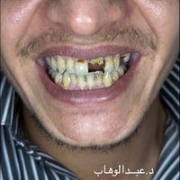 بناء سن • جلسة واحدة • الحود