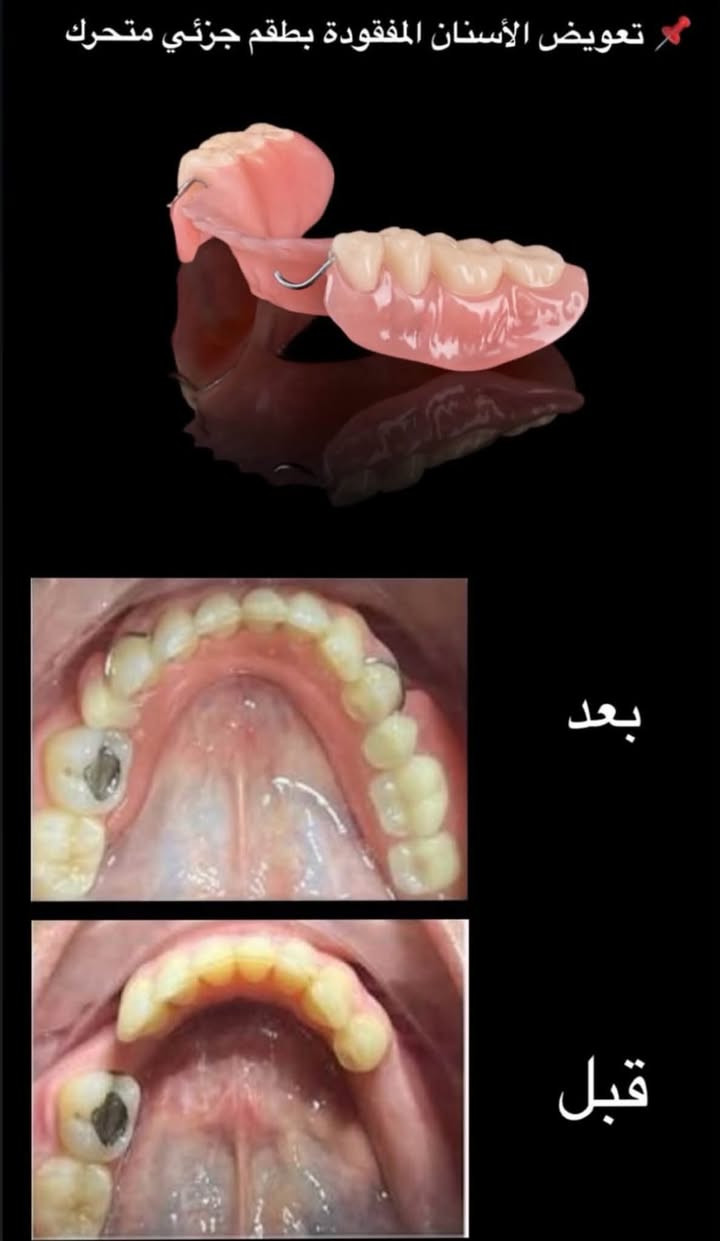 لا توجد تفاصيل

نص مكتوب في الصور:
- د. رقية عبد الرحيم الياسري • قلع الأسنان وبقايا الجذور • تنظيف الأسنان وإزالة التكلسات • حشوات الضوئية والتجميلية • تعويض الأسنان المفقودة بطقم متحرك العلاج مجاني بإشراف كادر طبي متخصص احجز الآن *********** @mr2hf العنوان عيادات بيارق العميد_السعيدوية_خلف مول الحارث
- تعلن عيادات جامعة العميد التخصصية لطب الأسنان عن بدء استقبالها للمراجعين وتقديم الخدمات الطبية التالية مجاناً بإشراف نخبة من الأطباء الاختصاص تنظيف أسنان وازاله تكلسات (مجاناً) كافة أنواع الحشوات الضوئية والتجميلية (مجاناً) قلع بقايا الجذور والأسنان تالفه (مجاناً) تعويض اسنان المفقوده بطقم متحرك (مجاناً) للحجز والاستفسار المراسله خاص العنوان: عيادات جامعة العميد / السعدية خلف مول الحارث مجاور مركز شرطة المخيم
- تعويض الأسنان المفقودة بطقم جزئي متحرك بعد قبل
- قلع الأسنان والجذور التالفة