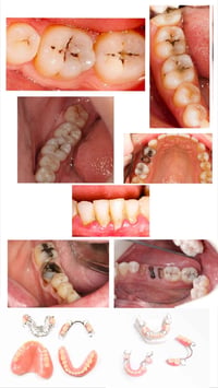 حشوات مجانية • طقم متحرك • جامعة الموصل