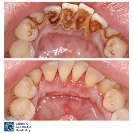 تنظيف اسنان مجاني • جامعة الرافدين • عيادة تجميل