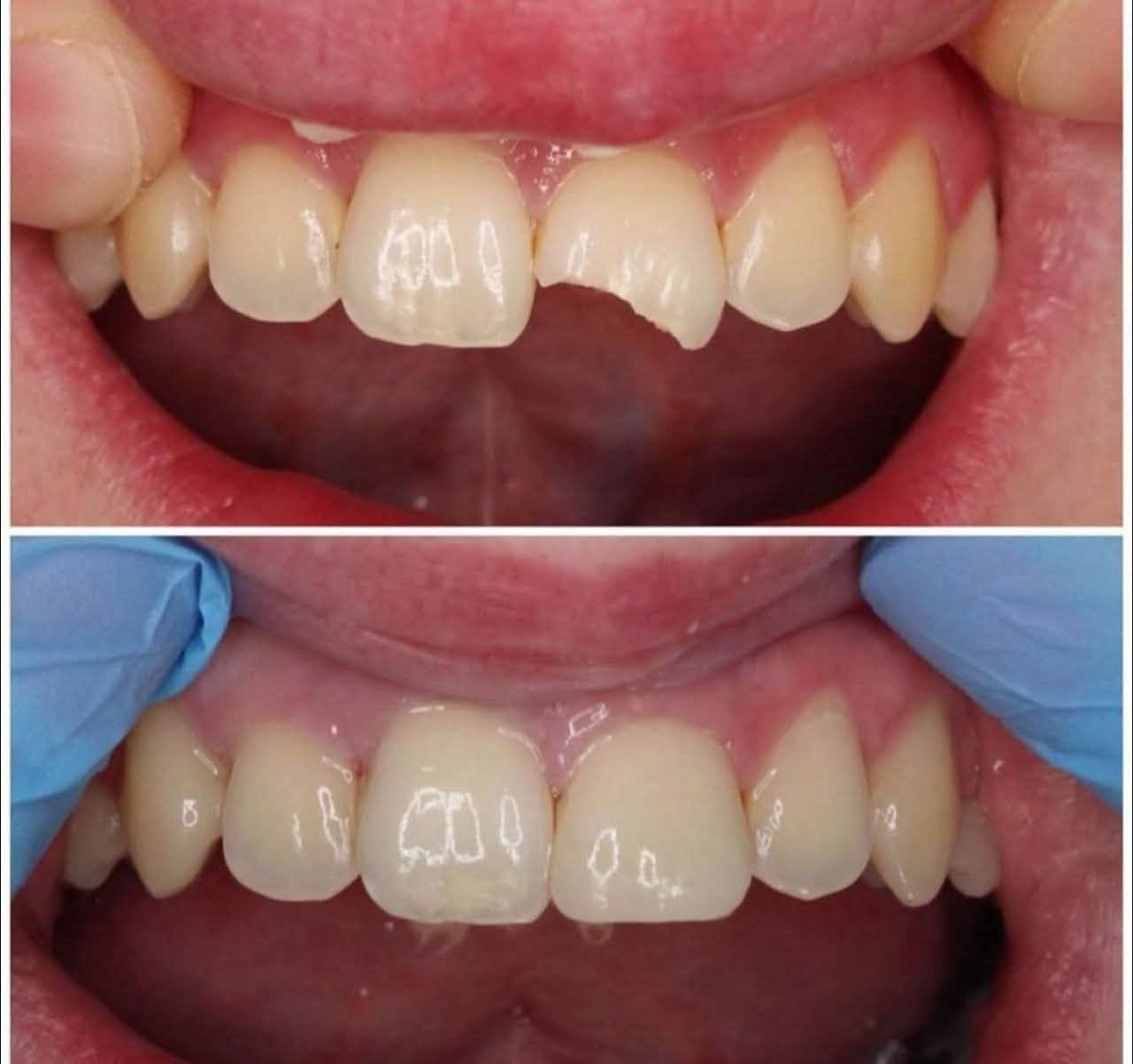 متوفر عدنا علاج الاسنان مجاناً بالكامل
تحت إشراف أطباء مختصين
خدمتنا:
حشوات للاسنان 
قلع الاسنان او الجذور المتبقية
تنظيف الاسنان 
موقعنا: كربلاء _ خلف مول الحارث_ سيطرت السعديه
للتواصل عبر الوتساب او الاتصال على الرقم
***********

نص مكتوب في الصور:
- معاً نحو ابتسامة أجمل مجاناً 1 قلع الأسنان والجذور المتبقية 2 حشوات ضوئية 3 تنظيف الأسنان 4 تعويض الأسنان بطقم متحرك الدكتور: مصطفى حيدر كربلاء - السعدية خلف مول الحارث ( عيادات بيارق العميد التعليمية ) *********** صحتك .. ابتسامتك
- BEFORE AFTER