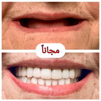 عيادات الكفيل • علاج مجاني • طقم أسنان