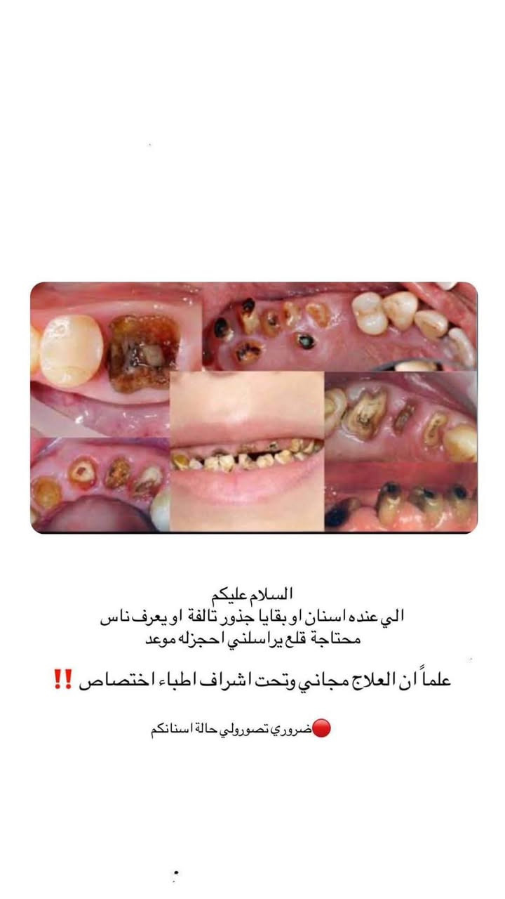 كربلاء الجمعيه • حشوات دائمة • علاج مجاني