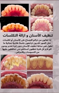 تنظيف أسنان • إزالة تكلسات • جلسة مجانية