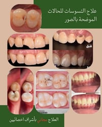 تنظيف تسوس • مجاني • عيادات جامعة اهل البيت