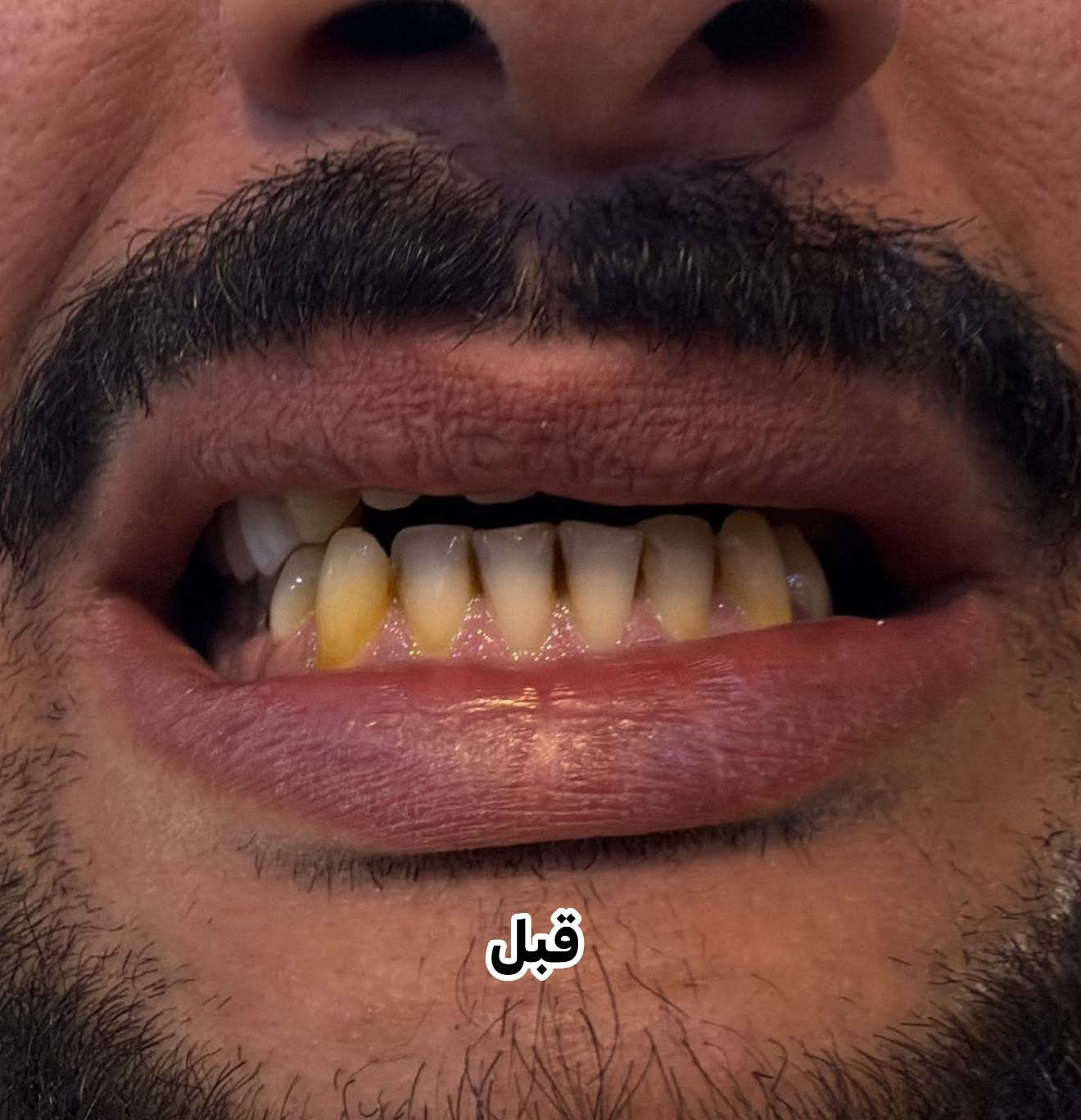 تبييض أسنان • قبل وبعد • مركز سومر