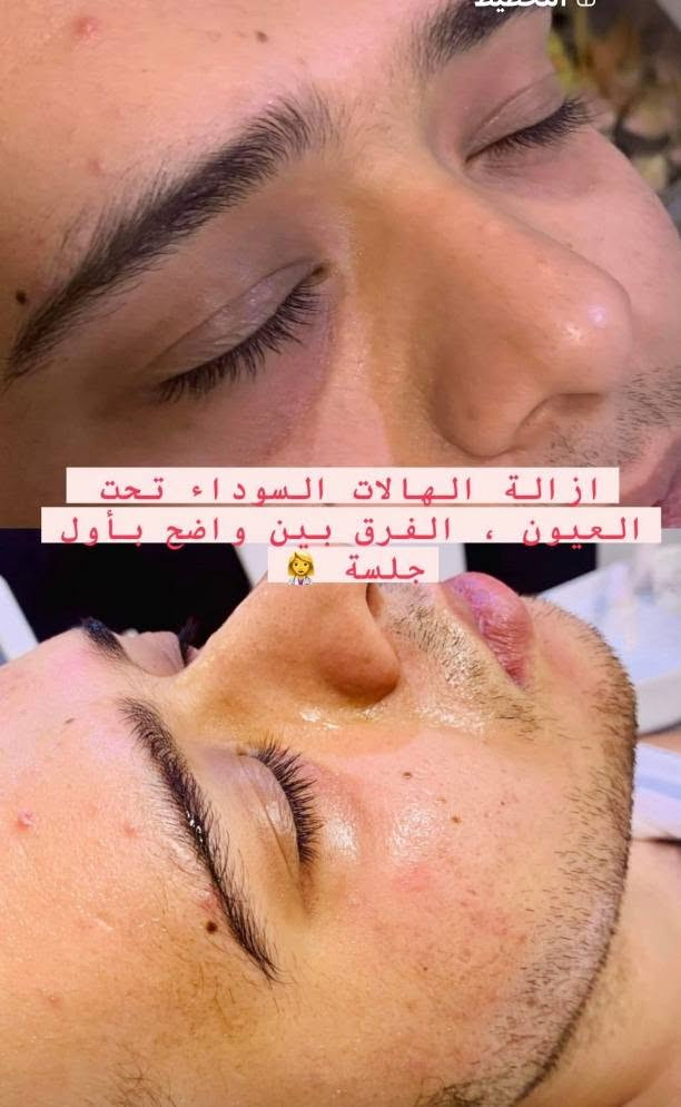 على بركة الله

الافتتاح غدا الجمعة 

عيادة الهدى لطب الأسنان
الدكتورة الاختصاص والخبرة الطويلة في هذا المجال

جنان حميد الركابي

مجمع سما الطبي مجاور صيدلية فلاح حسن مكحول
قلعة سكر /تقاطع الجدوع

نص مكتوب في الصور:
- جلسه عنايه وشد الترهلات والنتيجه ظهرت اثناء الجلسه
- ازالة الهالات السوداء تحت العيون ، الفرق بين واضح بأول جلسة 👩‍⚕️
- وداعاً لبرد الأسنان العلاج عندي 100% آمن وبدون برد alhuda.dental.rafai Antivet Before After Case: Fluorosis stains Painlessly, permanently remove stains in one sitting! MDC DENTAL www.dental.us
- صحة جمال ثقة لأنك تستحق الأفضل عيادة الهدى لطب الأسنان قسم التجميل اللا جراحي لأبتسامة أكثر جمالاً .. وحياة أكثر ثقة ابتسامتك .. حكايتنا تركيبات الأسنان تصميم الابتسامة تنظيف الأسنان عدسات الأسنان التجميلية تبييض الأسنان معاَ .. لابتسامة أجمل لأن ابتسامتك تستحق الأفضل فريق متخصص لخدمتكم رعاية مهنية بأحدث التقنيات
- على بركة الله تعالى عيادة الدكتورة جنان الركابي تم افتتاح عيادة الهدى لطب وتجميل الأسنان تركب الاسنان تقويم الاسنان تنظيف تجميل لا جراحي حشوات فلر الدكتورة الاختصاص جنان حميد الركابي كادر طبي أخصائي رجالي ونسائي متكامل العنوان تقاطع الجدوع قلعة سكر مجمع سما الطبي مجاور صيدلية فلاح حسن مكحول التاريخ الجمعة 25/9/2026 رقم الحجز *********** الدوام طيلة أيام الأسبوع
