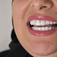 تبييض أسنان • مركز تجميل أسنان • بسماية بغداد
