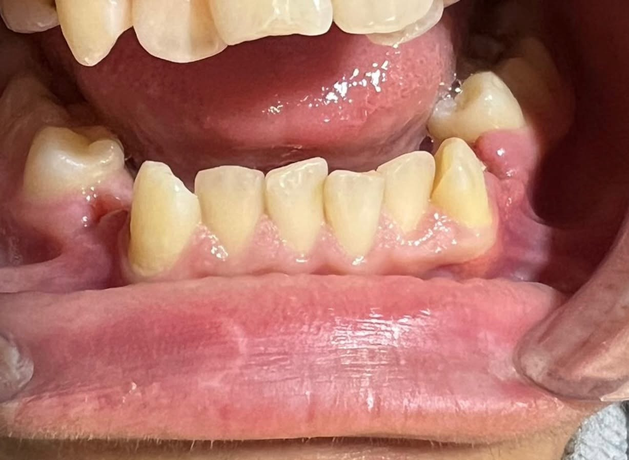 التقويم يميزنا احد اعقد و اصعب الحالات عدم انتظام و ازدحام شديد في ترتيب الاسنان ماشالله الوصول الى مراحل شبه نهائية الصور تتكلم …. علاج جميع الحالات الصعبة و المعقدة نتائج مضمونة خبرة طويلة في مجال الحالات المعقدة دقة طبية في التعامل ابتسامة مثاليه اسعار مناسبة بالتقسيط المريح… دكتور غزوان مزهر بغداد الكرخ نفق الشرطة بداية شارع الاطباء عيادة لوركا فوق صيدلية كنز النفق متوفر واتس *********** #تقويم_الاسنان #تقدم_الفك_السفلي #تقويم_الشفاف #تقويم_الدايمون #زراعة_الاسنان @تغليف_الاسنان_الزاركون

