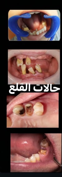علاج مجاني • قلع أسنان • حشوة ضوئية