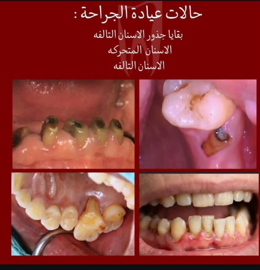 الى كل اهالي الدورة الاحباء حبينا نذكركم ما تهملون اسنانكم ! اهالينا كبار وصغار😍
صراحة الدكتورة ما اعرفها لكن على شغلها والدقة كلت ضروري اي شخص بالدورة او قريب من الدورة يعاني من اي مشكلة من المشاكل الموجودة تحت في الصور 
شغل نظيف ايد خفيفة والاهتمام بكل التفاصيل 
طبعا لليسألون الدكتورة تشتغل داخل عيادات جامعة دجلة لطب الاسنان مجانااا مجانااا 
اذا حابين تعرفون تفاصيل اكثر وايام الشغل تواصلوا مع الرقم واتساب رصيد موجود
***********

نص مكتوب في الصور:
- حالات عيادة التنظيف : التكلساات التصبغات بسبب التدخين والمشروبات اي احد يحب يسوي تنظيف يكدر يتواصل ويايه ( اللي موضح بلصوره كذلك )
- حالات عيادة الجراحة : بقايا جذور الاسنان التالفه الاسنان المتحركه الاسنان التالفه
- 5
- حالات عيادة التعويض :
- تعويض الاسنان المفقوده بطقم جزئي متحرك مثل الحالات الموضحه بلصور
- ovable Upper & Lower Partial Dentur
- BEFORE
- AFTER
- efore
- 600 x 38
- حالات عيادة الحشوات : حافات الاسنان المكسوره تسوس قريب اللثه ازالة الحشوات القديمة تسوس على سطح السن بين الاسنان الخلفيه بين الاسنان الامامية