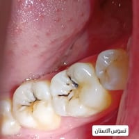 حشوات ضوئية • علاج أسنان • بغداد الحسينية