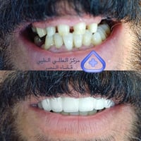 تجميل أسنان • قبل وبعد • الصوب الكبير