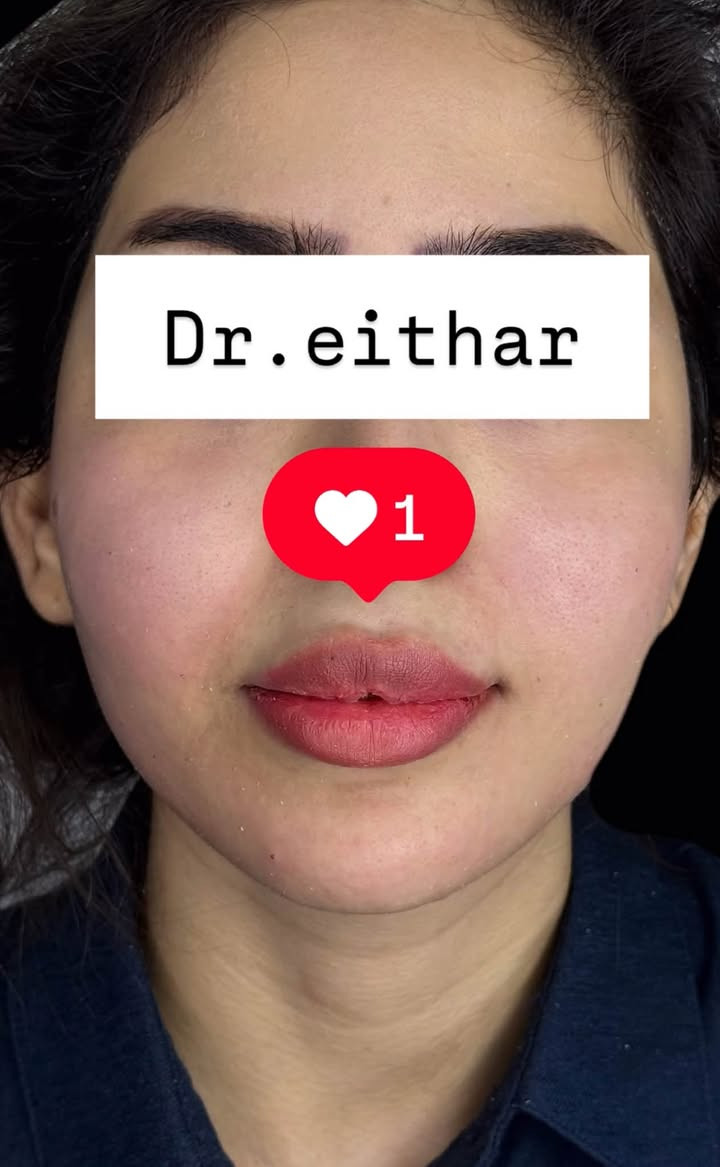 كونتور الوجه وشد بالفلر  (لفتنك وجنات  واصداغ وتدوير الفك والذقن ونظاره) 🔥🔥🔥

اتمددت عروووض للكادر التدريسي والخريجات والموظفات والعروسات لنهايه الاسبوع ليوم الاربعاء اخر يوم  ثبتتهه الكم بالستوري بالهايلايت وببوست اعلى الصفحة ✨✨

د.ايثار سامي عبد الامير
واسط الكوت الهوره مجمع القبطان طابق اول 

الحجز***********

نص مكتوب في الصور:
- Dr.eithar 1
- Dr.eithar
- 1