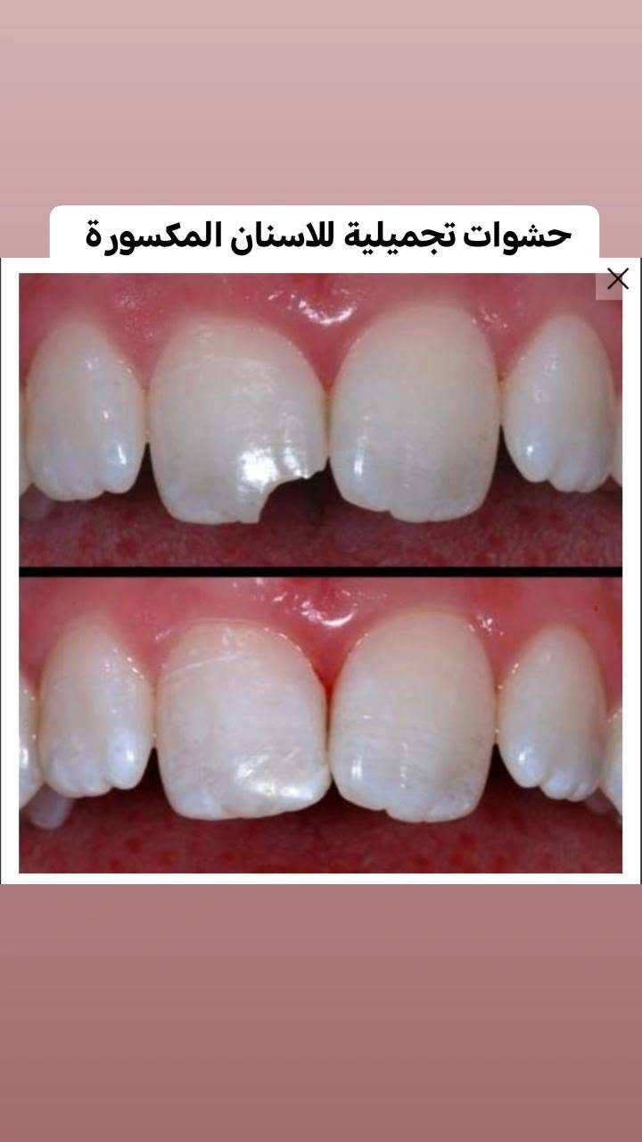 السلام عليكم العلاج مجاني للي عنده هيج حالة 
للتواصل واتساب ***********
او التواصل خاص 
العلاج تحت اشراف اطباء متخصصين 
العنوان:جامعة اشور شارع مطار المثنى

نص مكتوب في الصور:
- براء خالد غيلان طبيبة أسنان حشوات تجميلية قلع أسنان تنظيف أسنان وإزالة تكلسات تعويض أسنان مفقودة العلاج مجاني تحت إشراف مختصين *********** b0ara جامعة اشور شارع مطار المثنى
- تنظيف الاسنان وازالة التكلسات
- قلع جذور متبقية
- حشوات تجميلية للاسنان المكسورة
- Dr. Salah
- Abdullahteeth
- ALKHAZAN