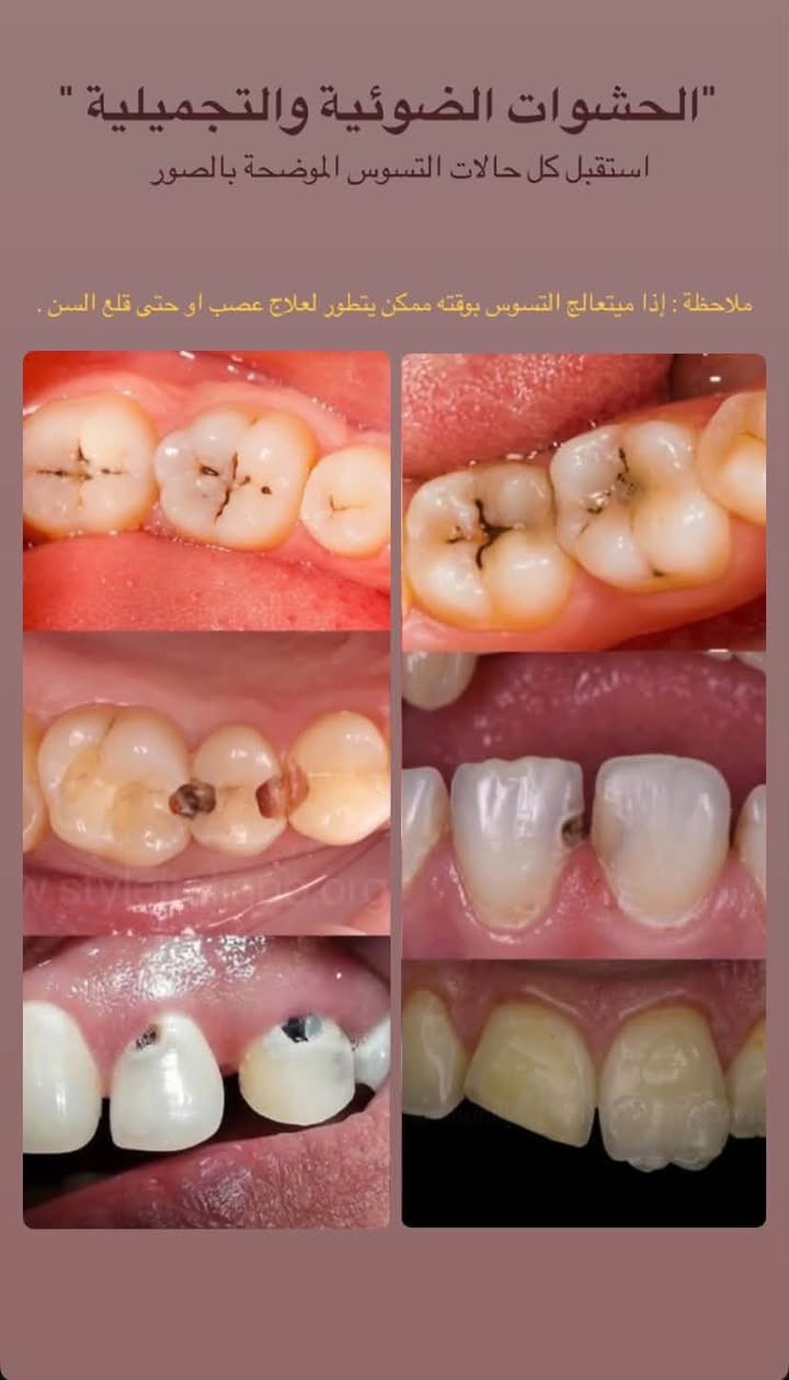 تنظيف أسنان • قلع أسنان • علاج مجاني