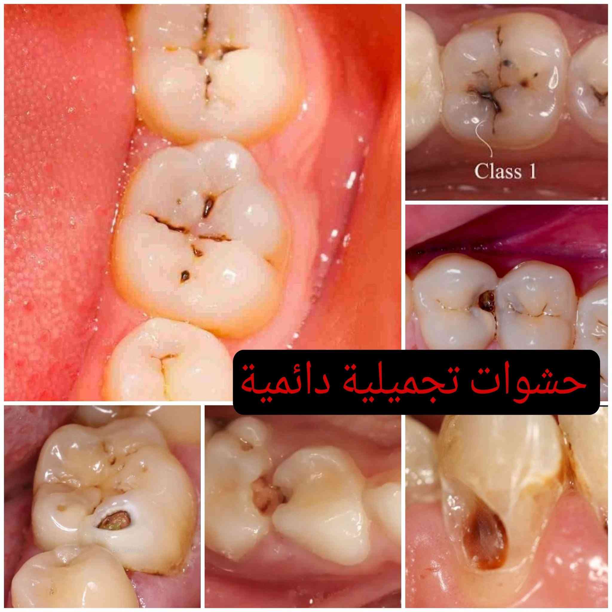 السلام عليكم ♥️♥️متوفر علاج مجاني بالكامل اللي عنده حشوة تنظيف وقلع تعويض اسنان وتحت أشراف مجموعة من الاستاذة النخبة الاختصاص في عيادات جامعة دجلة 
للتفاصيل اكثر واتساب +9647762435273

نص مكتوب في الصور:
- تنظيف وازالة التكلسات
- Class 1 حشوات تجميلية دائمة
- قلع الاسنان التالفة والمتحركة والجذور المتبقية
- تعويض الاسنان باطقم جزئية