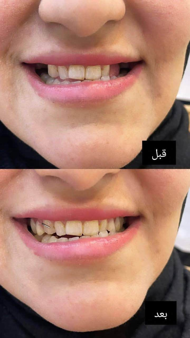 علاج أسنان مجاني • حشوات تجميلية • شارع فلسطين