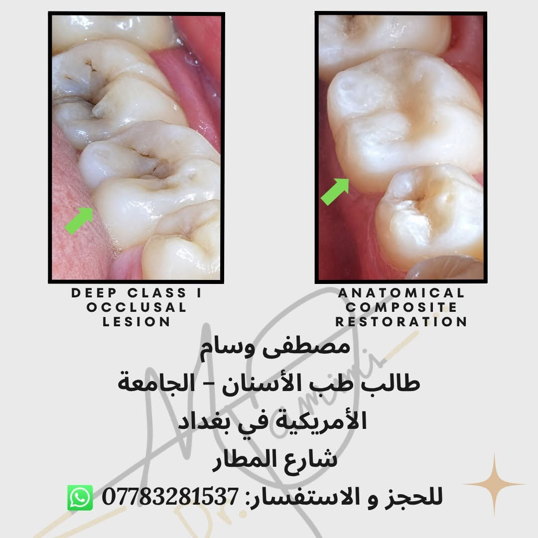 🦷 فرصة علاج الأسنان في عيادات الجامعة الأمريكية في بغداد
العلاج يتم تحت إشراف أطباء اختصاص وضمن نظام تشخيص أكاديمي دقيق.
✔️ حشوات تجميلية
✔️ تنظيف أسنان
✔️ حشوات جذور
✔️اعادة علاج حشوات الجذور الفاشلة سابقا Endodontic Retreatment
✔️زراعة اسنان
✔️عمليات زراعة العظم Bone Augmentation/Graft
✔️ تراكيب سنية
✔️ فحص وتشخيص كامل, جميع انواع الاشعة Intra oral, OPG, CBCT
📍 الموقع: الجامعة الأمريكية في بغداد – شارع المطار
📞 للحجز والاستفسار (واتساب): ***********
او للتسجيل السريع على الرابط التالي:
https://forms.office.com/r/Tfw1V8bL6t?origin=lprLink
⚠️ الإعلان لغرض تنسيق المواعيد ولا يمثل جهة رسمية تابعة للجامعة.
صور الجامعة من auib_shine
