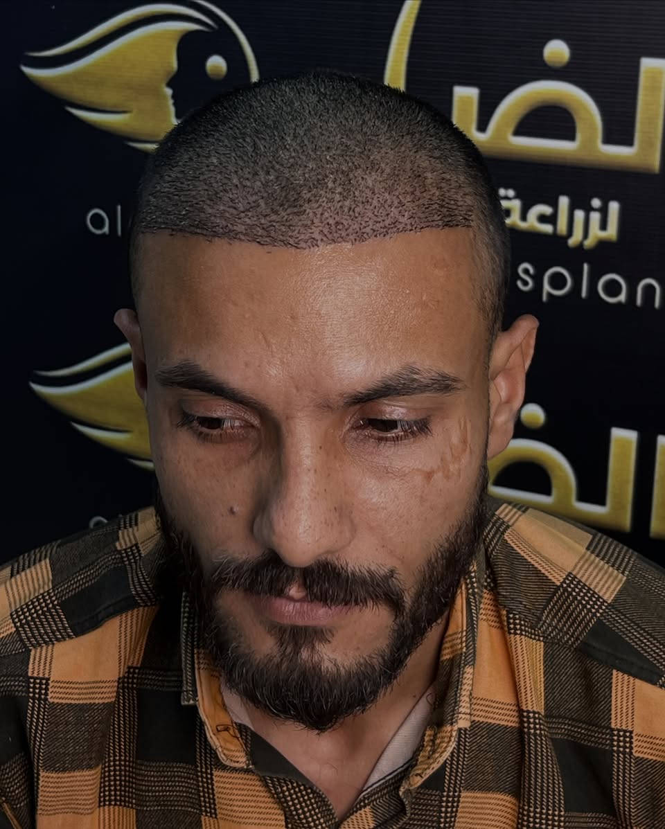 عدد البصيلات؟ مفتوح ✨
الكثافة؟ 100% ✨
النتيجة؟ شعر طبيعي يندمج مع شعرك الأصلي دون فرق.

في الضامن، هدفنا مو مجرد تغطية الفراغات، هدفنا الوصول لأعلى كثافة ممكنة تناسب حالتك وتمنحك مظهراً طبيعياً وثقة أكبر. 💙�

🔷العنوان: 
كربلاء المقدسة: الاسكان _ خلف القنصلية الايرانية _ مجمع العيادة الاولى
***********
بغداد: الاعظمية - ساحة عنتر -مستشفى دجلة الاهلي⁩⁩
***********

#الضامن_لزراعة_الشعر #زراعة_الشعر #كثافة_100 #نتائج_طبيعية #بغداد_كربلاء
⁩⁩⁩

نص مكتوب في الصور:
- الضامن لزراعة الشعر
- قبل
- بعد
- الضامن لزراعة الشعر aldhamin hairtransplant
- كربلاء - الاسكان- خلف القنصلية الايرانية- مجمع العيادة الاولى
- (***********)
- بغداد - الاعظمية - ساحة عنتر- مستشفى دجلة الاهلي
- (***********)