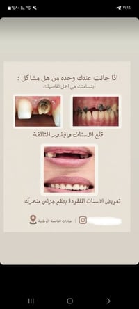 مجاني • عيادات الجامعة الوطنية • قلع اسنان وجذور