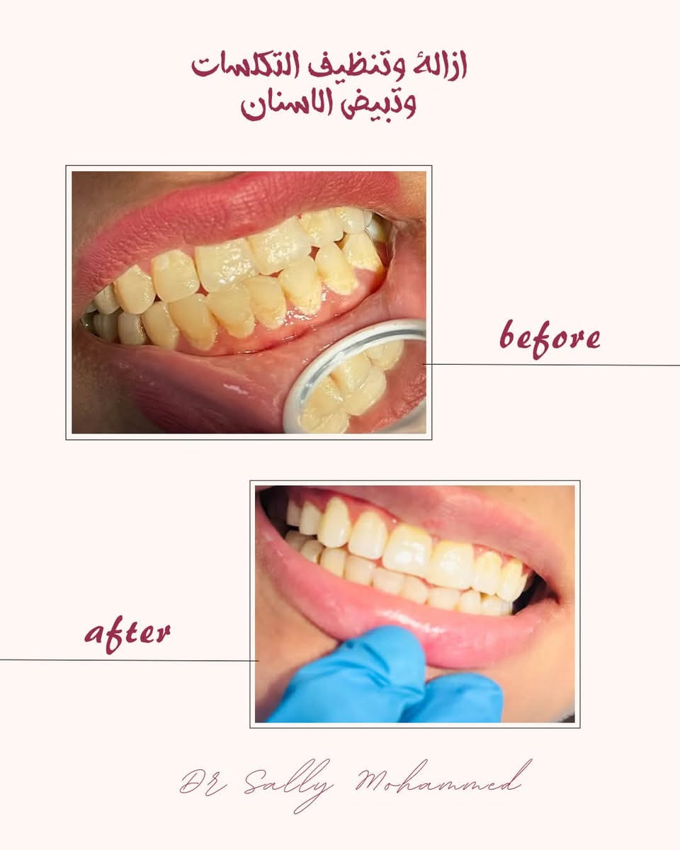 حشوات ضوئية • تنظيف تكلسات • علاج مجاني