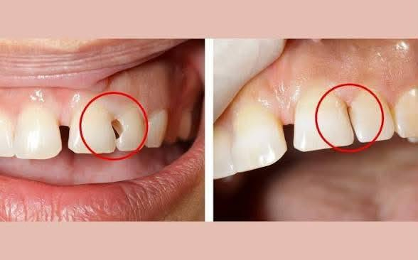 السلام عليكم
احنه طالبات طب اسنان مرحلة رابعة - جامعة السليمانية 
مستعدين لأستقبال حالات قلع، تنظيف، حشوات، بأسعار رمزية او مجاناً (العدد محدود)
(اذا عندك الم غير محتمل بالسن او  جدك او بيبيتك يحتاجون قلع لاسنانهم حتى يسوون تخم ويكدرون ياكلون براحتهم او اذا عندك جذور تريد تقلعهم قبل الزراعة او الجسر، او اذا طفلك اسنانه مسوسة و تريد عيادة مخصصة للاطفال) تعالو تفضلو للعيادة حتى يتم فحص المريض من قبل دكتور الاسنان ويقرر العلاج المناسب

للاستفسار يرجى الرد على البوست او ارسال رسالة على الخاص  او الرقم ***********
او تواصلو مباشرةً على الصفحة
