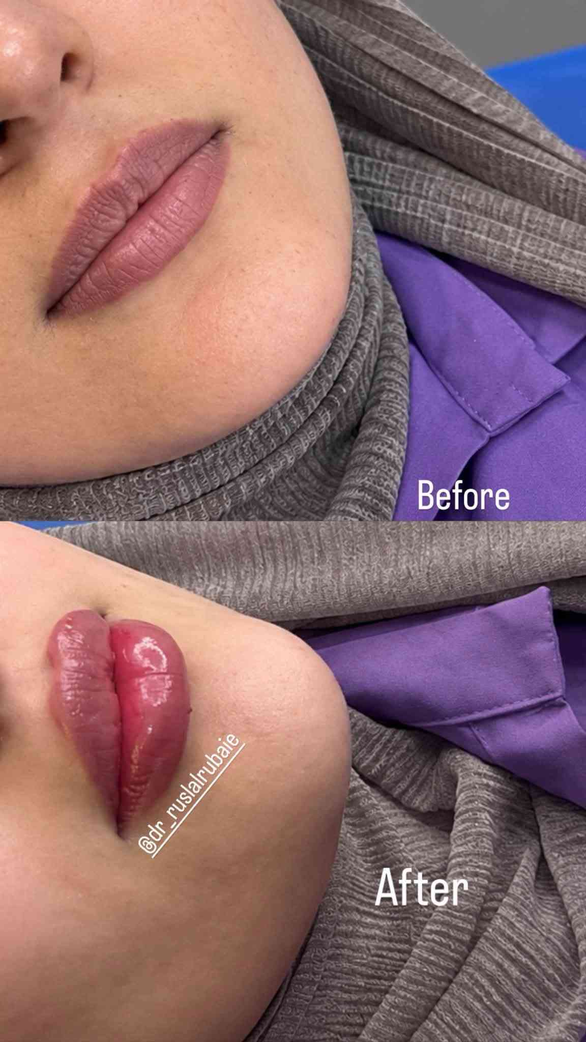 عروض شهر التاسع
مراجعاتي  الحلوات ورأيهم صوت وصوره ماشاءالله الفرق ديشوفو من اول الجلسات لان الاختيار يكون مو عشوائي كل مراجعة نختارلها مكس او ابرة خاصة لحالتها💉💗💗👏 وهو هذا الشغل الصح الي يخليكم تشوفون فرق من الجلسة الاولى 💉🍓

بخصوص العروض مراح تتكرر بعد ابداً لان اقوى عروض سويناهه 

خلال شهر التاسع واقبالكم عليه جداً عالي 💉👏

بخصوص كل المواد الجديدة الي تنزل داخل العياده تكدرون تتابعون صفحة الانستكرام 

https://www.instagram.com/p/DbWWdUhsNAt/?stkn=Z2EwenVjcm5rOXFu

او صفحتنا على الفيسبوك DrRusl Alrubaie

او مراسلتنا واتساب مسج فقط ***********

نص مكتوب في الصور:
- نتائج استمرار المراجعة بحقن ابر النضاره شهريا 0 ماشاء الله تلمع 🤭 ✨✨ وهذا السر الي يخليكم تشوفون فرق لان اختيار الابره يكون حسب الحالة ✨ @DrRusl_Alrubaie
- @dr_Ruslalrubaie
- Before @dr_ruslalrubaie After
- متواجدة دكتورة اهلا حبيبتي نعم متواجدة 9:44 AM مرحبا دكتورة دكتور تقطيع ألياف الحالة شكد PM مراحب حبيتي You replied ما شاء الله حالة مراجعتي تعاني من ندب ومسام واسع بسبب اثار حب الشباب بججلستين بس حصلت نتيجة دكتور تقطيع ألياف الحالة شكد شلونها حالتي بعد الجلسة? Replied to you شلونها حالتي بعد الجلسة? تجنن دكتورة DrRusl Alrubaie@ يعني ميحتاجلي شي بس ضل شوية يعني كولش بسيط اثر شوية سطحي أما المسام كولش صغر Message...
