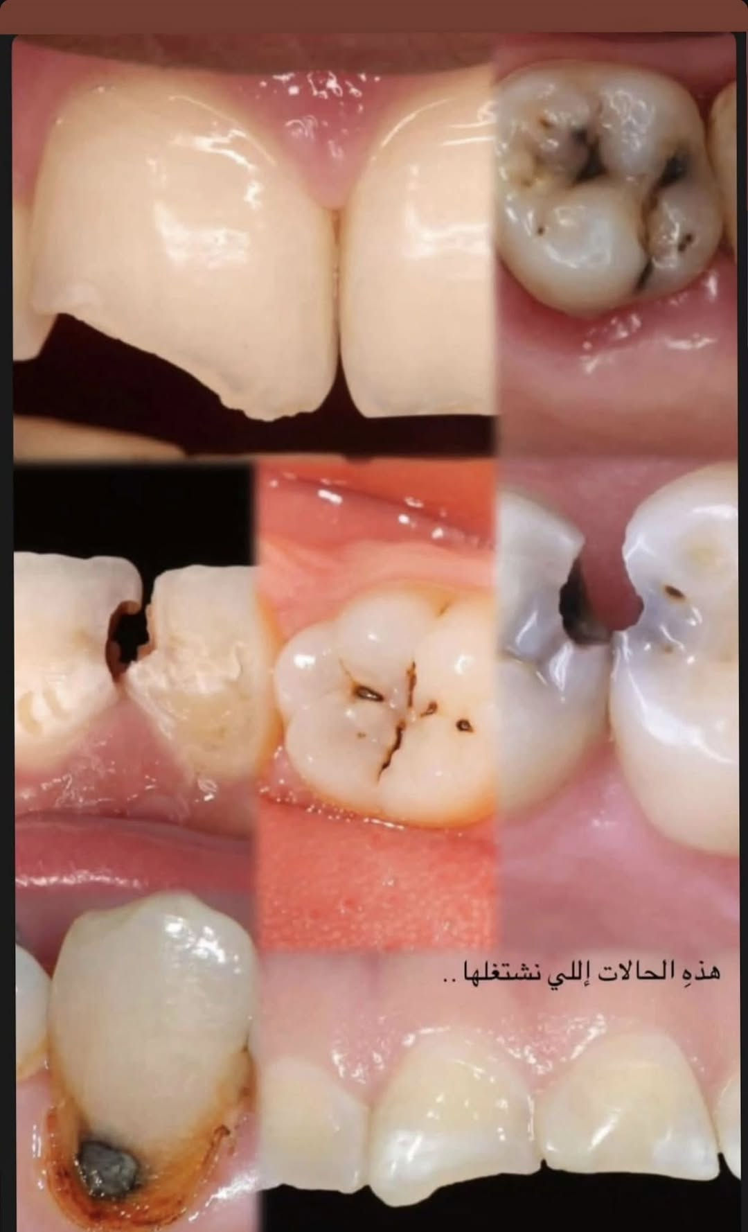 جامعة المنارة • حشوات ضوئية • مجاناً