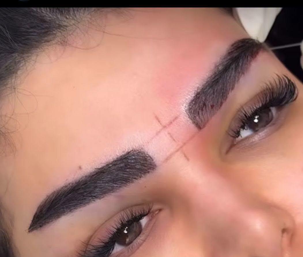 زراعة شعر • أخصائيين إيرانيين • الحلة