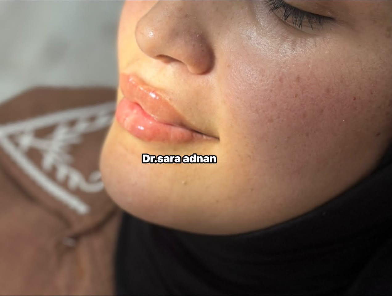 ✨ شفاه أكثر امتلاءً وتناسقًا بإطلالة طبيعية تبرز جمالكِ وثقتكِ بنفسكِ
💉 بإشراف د. ساره عدنان

#فلر_الشفاه #شفاه_ممتلئة #تجميل #جمال #عناية_بالبشرة #نتائج_طبيعية #د_ساره_عدنان #Beauty #LipFiller #AestheticMedicine

نص مكتوب في الصور:
- Dr.sara adnan