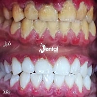 تنظيف أسنان • مجاني • عيادات جامعة العين