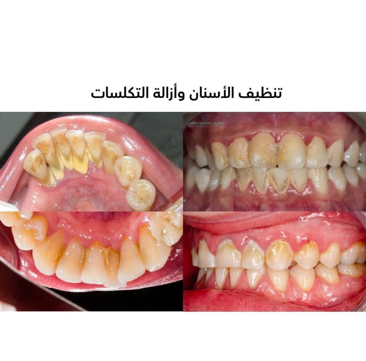مرحبا متوفر معالجة لِـ :
_ قلع الاسنان والجذور التالفة
_ ازالة التسوسات وتعويضها بحشوات ضوئية .
  _ تعويض الاسنان المفقودة بطقم كامل متحرك .
_ تنظيف الاسنان وازالة التكلسات .
_ حشوات جذرية للاسنان الامامية 
في عيادات جامعة المشرق
 
 العلاج مجاني

العنوان _ بغداد _ شارع المطار _ جامعة
المشرق
تواصل واتساب : ***********

نص مكتوب في الصور:
- تعويض الأسنان المفقودة بطقم جزئي متحرك
- تنظيف الأسنان وأزالة التكلسات
- علاج تسوس الأسنان بالحشوات الضوئية للحفاظ على أبتسامة صحية وجميلة
- قلع الأسنان والجذور التالفة
