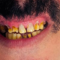 قبل 🦷  حالة كانت تعاني من تآكل وتصبغات وتفاوت في شكل الأسنان، مع حاجة ...