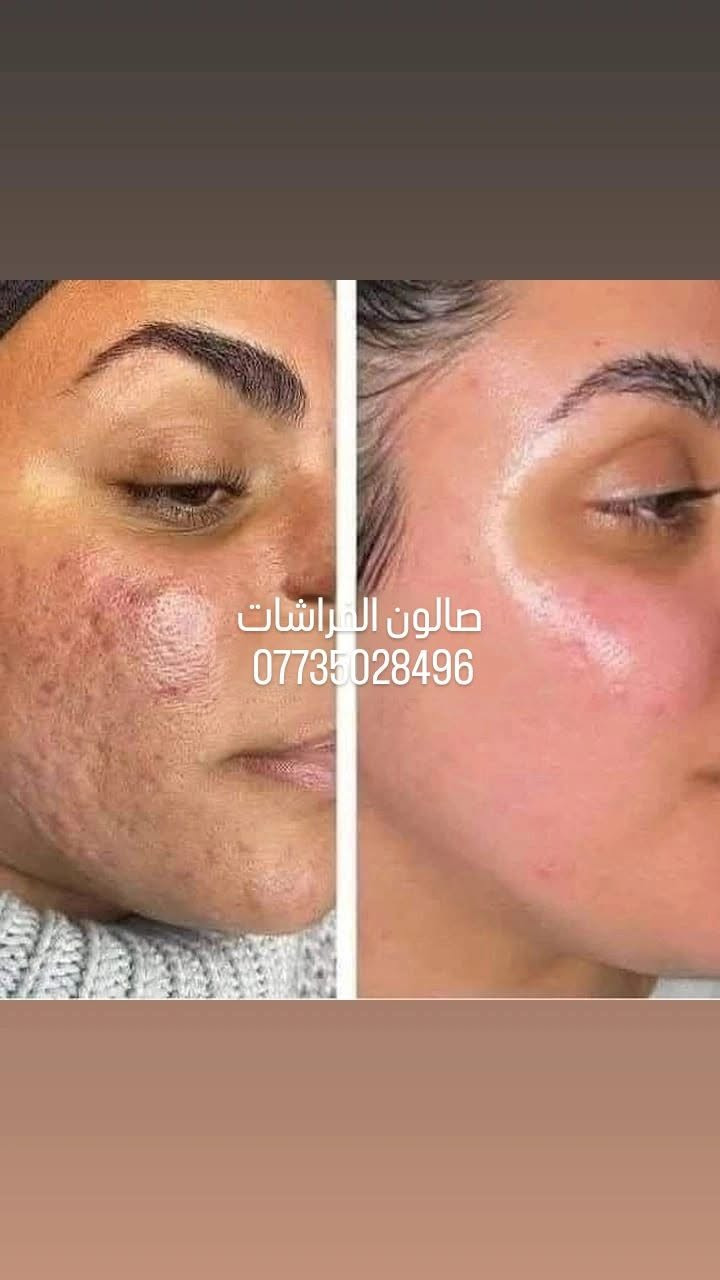 صباح الخير والعافية
*********** وتساب
صالون الفرشات

نص مكتوب في الصور:
- نتيجه الليزر بعد ثالث جلسه
- صالون الفراشات
- ***********