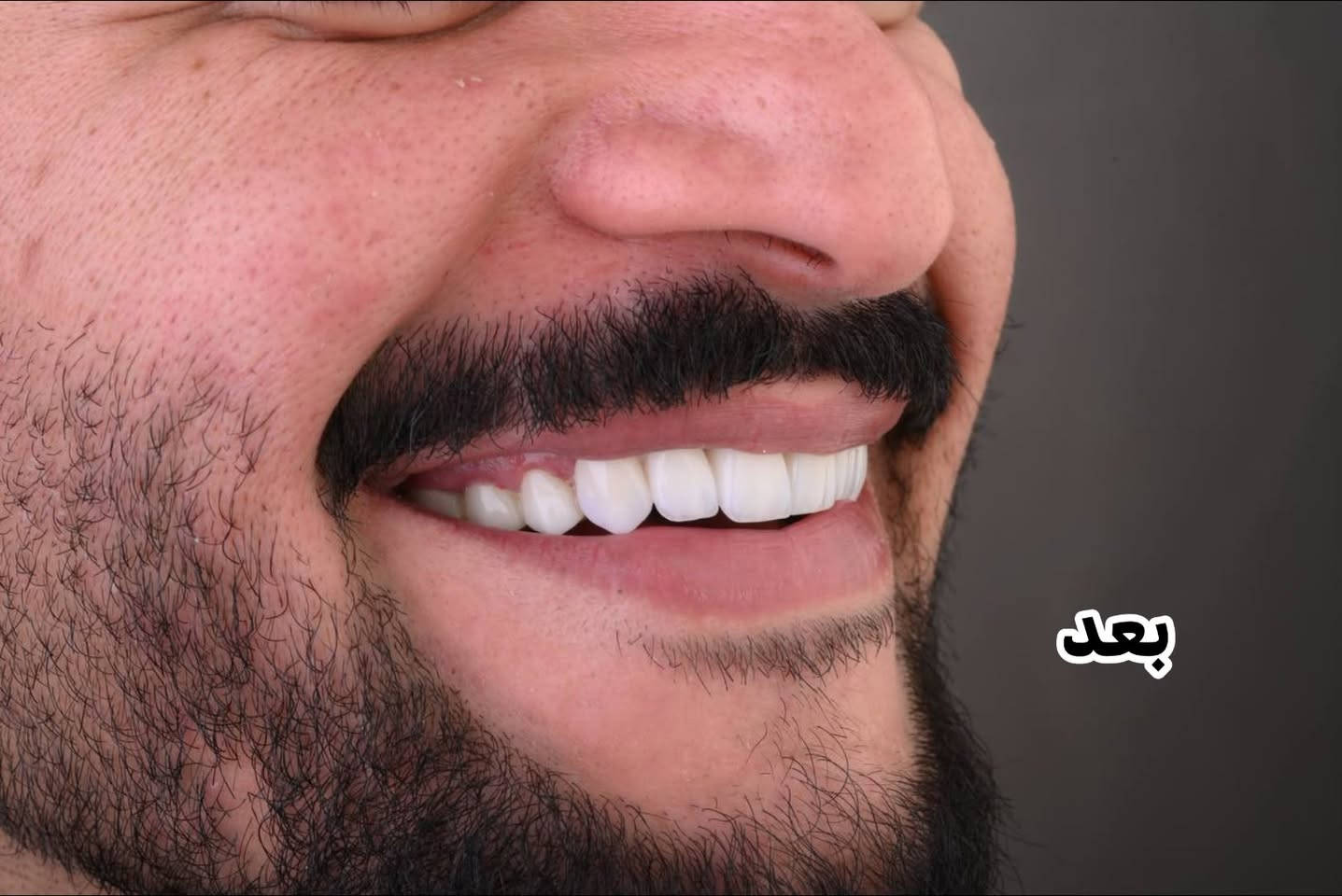 تبييض أسنان • قبل وبعد • مركز سومر