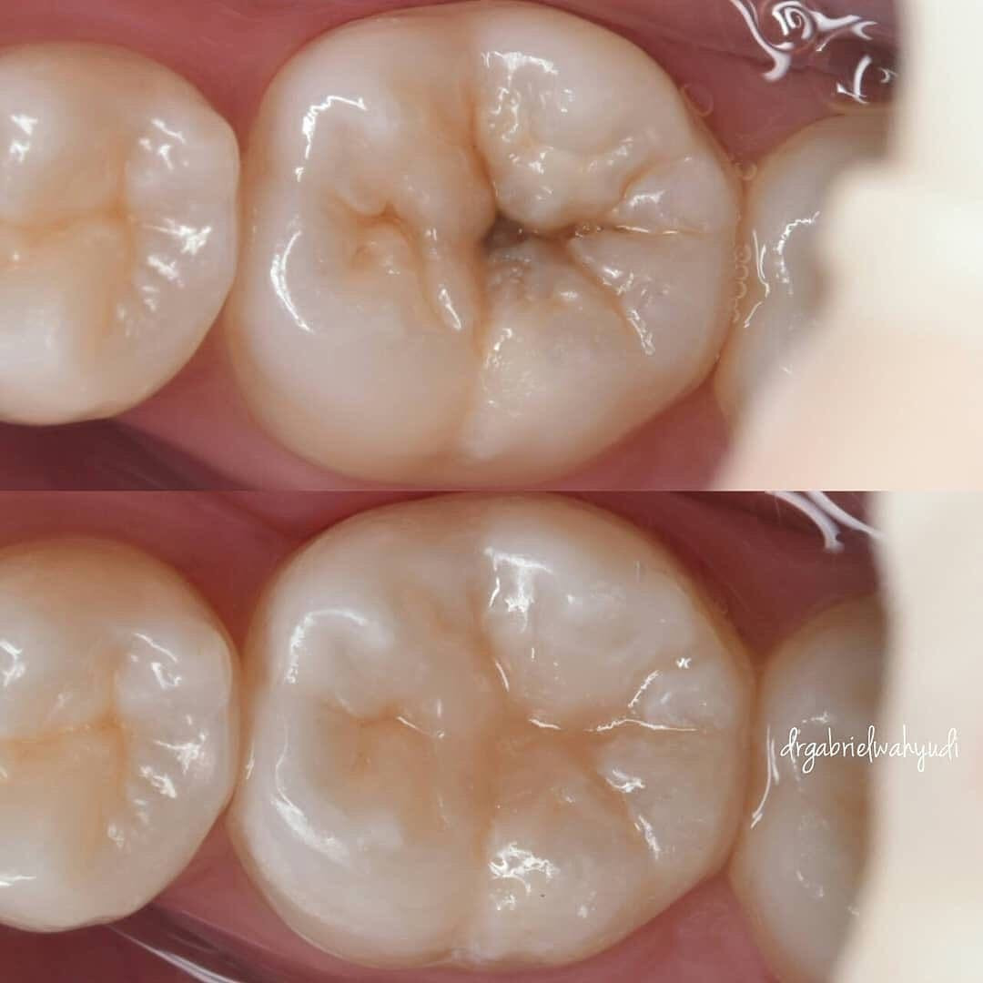 ابتسامتك تستحق عناية تليق بها
نقدّم لكم خدمات طب الأسنان في عيادات طب الأسنان - جامعة الكوفة، باهتمام ودقة وحرص على راحتكم.
خلف كلية الفقه
نظيف الأسنان وازالة التكلسات
حشوات تجميلية
تعويض الأسنان المفقودة
قلع الأسنان التالقة
والجذور المتبقية
***********
n.our.1_

نص مكتوب في الصور:
- drgabrielwahyudi