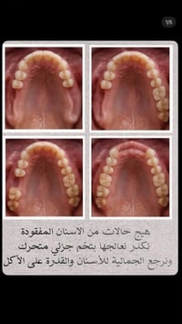 دكتورة آيات • طقم أسنان • قلع أسنان