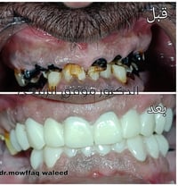 حشوات • تغليف أسنان • أبو غريب